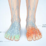 Digital graphic of 2 feet with labels pointing to tingling, burning sensation and numbness indicating neuropathy.