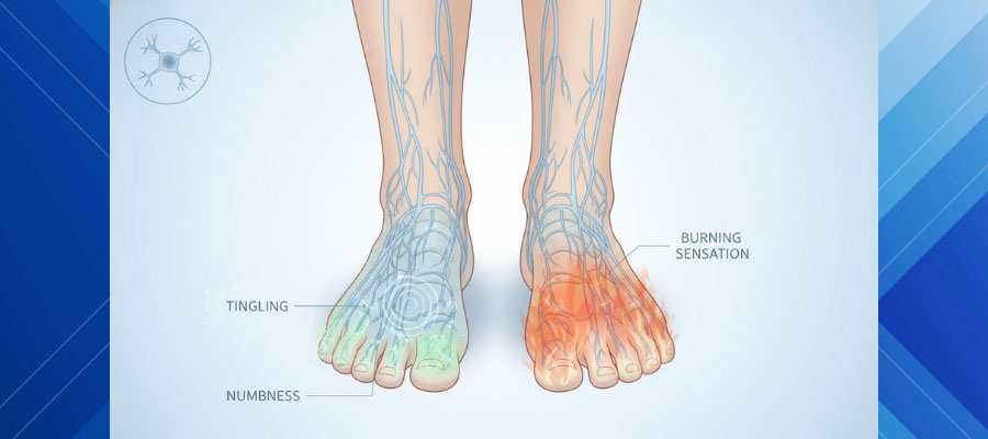 Digital graphic of 2 feet with labels pointing to tingling, burning sensation and numbness indicating neuropathy.